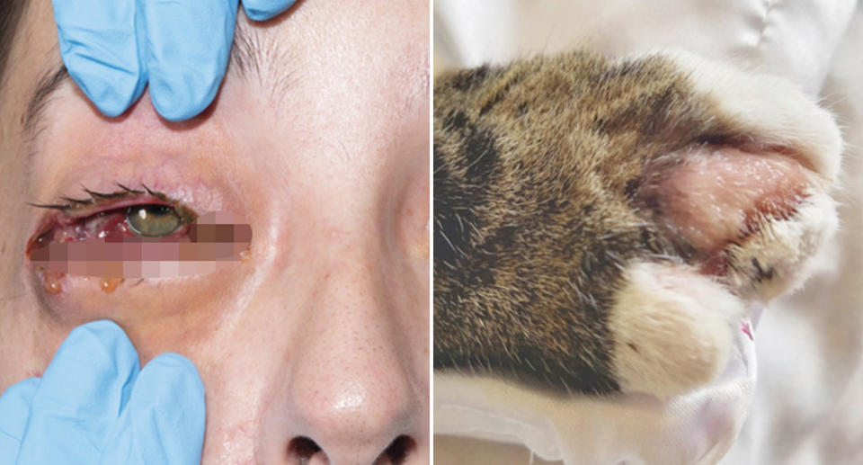 A woman, 28, seen with severe eye irritation caused from cowpox contracted from her pet cat (also pictured).