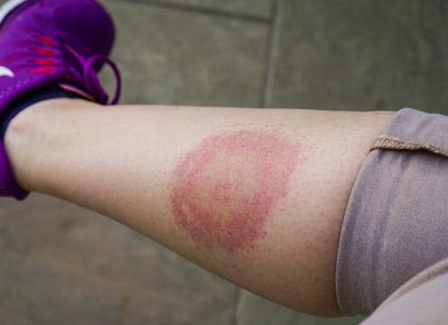 <span class="caption">Lyme disease: beware what bites you this summer. </span> <span class="attribution"><a class="link " href="https://www.shutterstock.com/download/success?u=http%3A%2F%2Fdownload.shutterstock.com%2Fgatekeeper%2FW3siZSI6MTU2MzgxNjE5MiwiYyI6Il9waG90b19zZXNzaW9uX2lkIiwiZGMiOiJpZGxfNTM3NTE4NDIyIiwiayI6InBob3RvLzUzNzUxODQyMi9tZWRpdW0uanBnIiwibSI6MSwiZCI6InNodXR0ZXJzdG9jay1tZWRpYSJ9LCJnUTJKd0sxRFNTQmlZM3VXekpkSzMxbmdjbTQiXQ%2Fshutterstock_537518422.jpg&ir=true&pi=33421636&m=537518422&src=y4ydMMXvbg4kDuYXj3RjTA-1-7" rel="nofollow noopener" target="_blank" data-ylk="slk:AnastasiaKopa/Shutterstock;elm:context_link;itc:0;sec:content-canvas">AnastasiaKopa/Shutterstock</a></span>