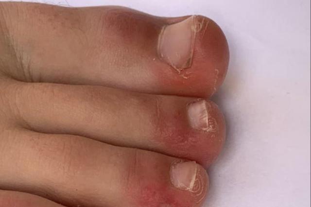 Mysterious wave of COVID toes still has scientists stumped