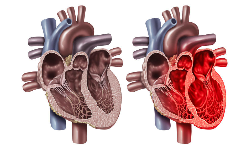 Broken Heart Syndrome or Takotsubo cardiomyopathy with a healthy organ anatomy cross section concept of an inner cardiovascular organ with enlarged swollen chamber in a 3D illustration style.