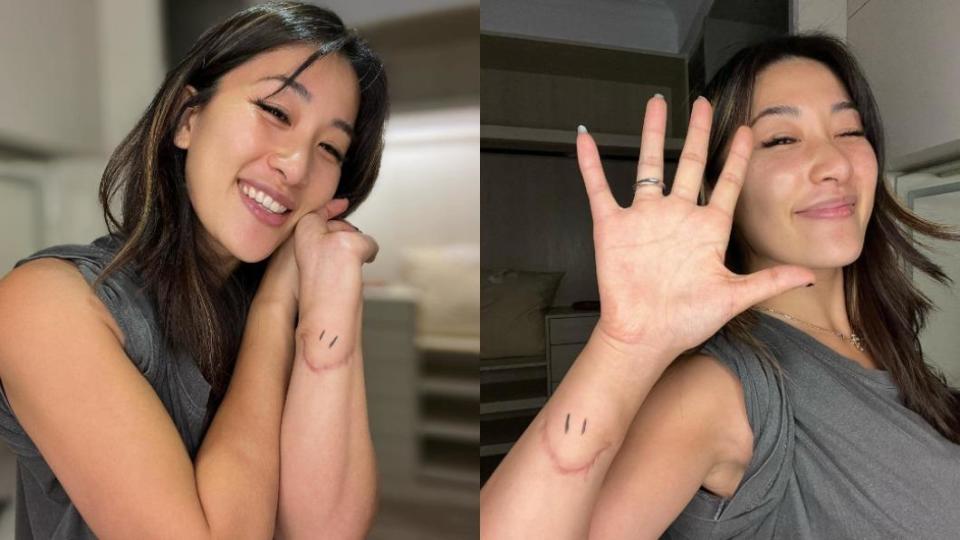 劉明湘的手上有著超深傷疤，更出現沾黏的狀況。（圖／翻攝自劉明湘臉書）