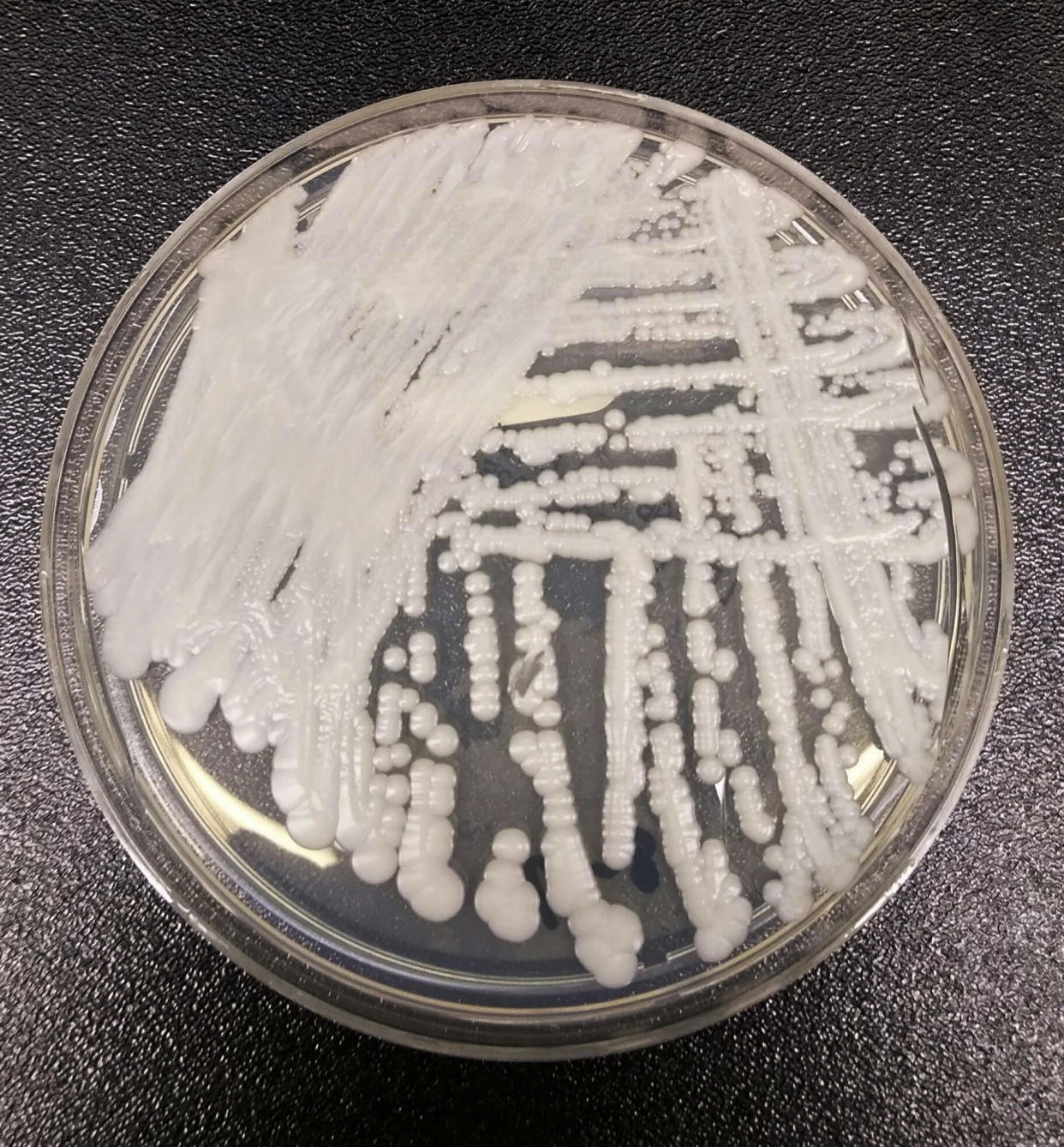 fungal FILE - This undated photo made available by the Centers for Disease Control and Prevention shows a strain of Candida auris cultured in a petri dish at a CDC laboratory. The U.S. toll of drug-resistant â€œsuperbugâ€ infections worsened during the first year of the COVID-19 pandemic, health officials said Tuesday, July 12, 2022. After years of decline, the nation in 2020 saw a 15% increase in hospital infections and deaths attributed to some of the most worrisome bacterial infections out there, according to a Centers for Disease Control and Prevention report. (Shawn Lockhart/Centers for Disease Control and Prevention via AP, File)