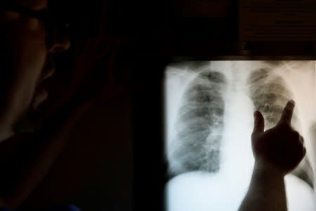 FILE PHOTO: Radiological technician Mark Davis looks at the chest x-ray of retired coal miner James Marcum, who has complicated black lung disease, at the Stone Mountain Health Services in St. Charles, Virginia, U.S., May 18, 2018.   REUTERS/Brian Snyder/File Photo