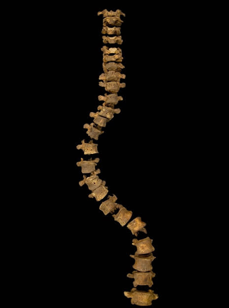 Here the spine of what has been confirmed to belong to King Richard III. The spine shows the king would've had so-called idiopathic adolescent-onset scoliosis, meaning the cause is unclear though the individual would have developed the disorder