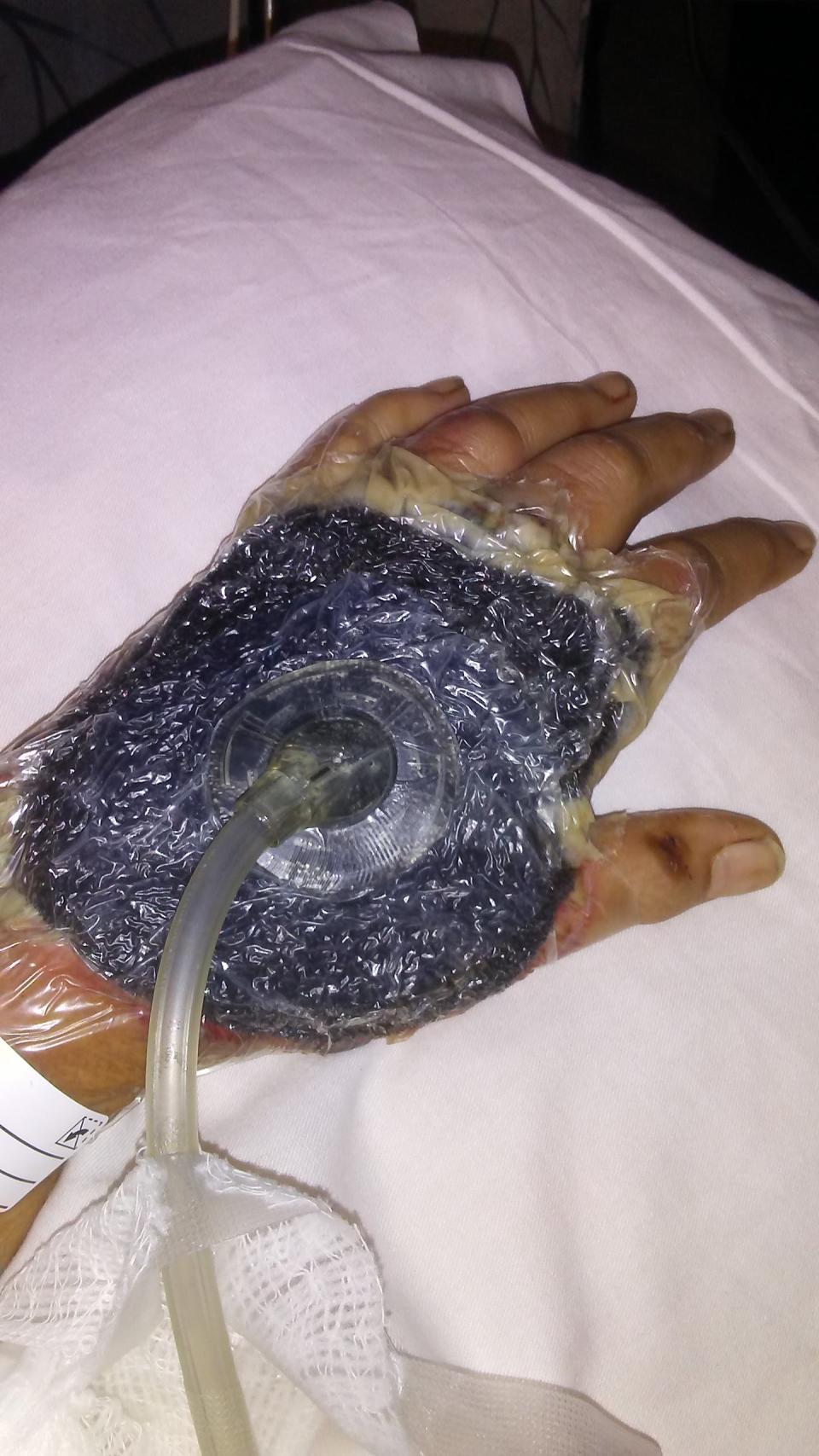 A vac seal covering the 49-year-old Hawaii woman's staph infection on her hand.