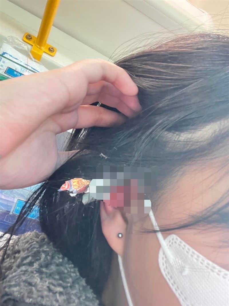 少女左耳被爆竹炸傷，耳膜破裂。（圖／翻攝自我是三峽人臉書社團，下同）