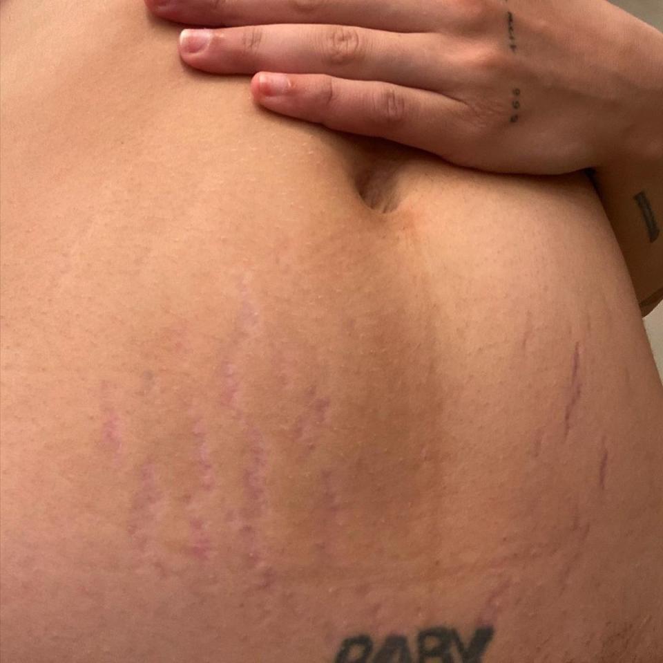 Halsey's stretch marks