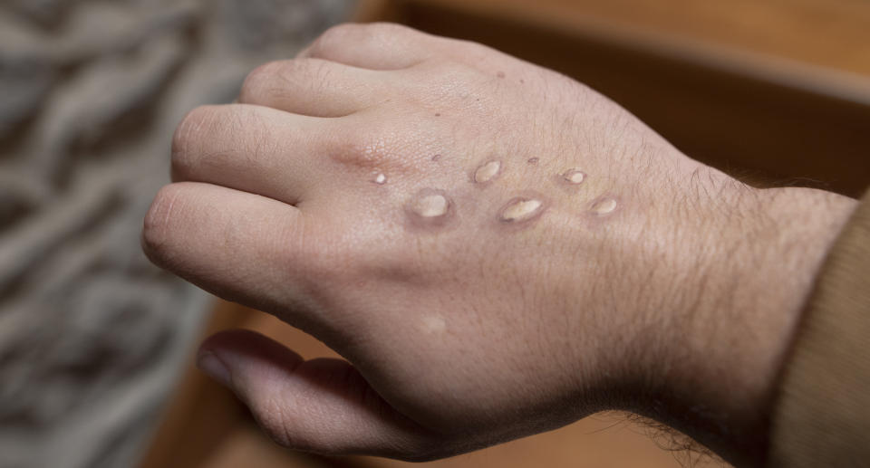 A monkeypox rash on a hand