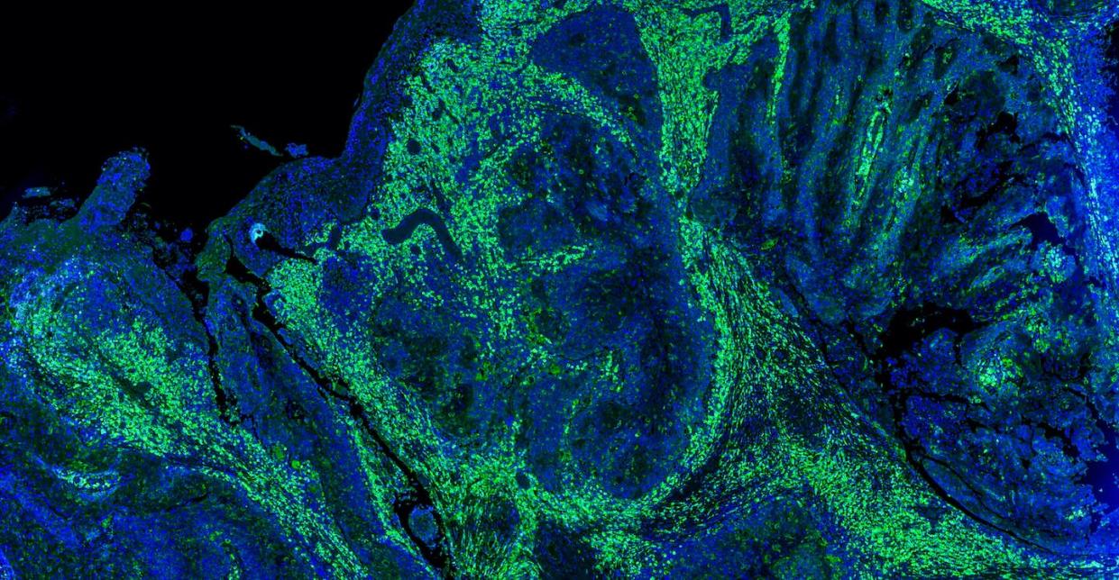 Tinción fluorescente de células cancerosas. <a href="https://www.shutterstock.com/es/image-photo/fluorescent-staining-tumour-cells-744318643" rel="nofollow noopener" target="_blank" data-ylk="slk:Carl Dupont / Shutterstock;elm:context_link;itc:0;sec:content-canvas" class="link ">Carl Dupont / Shutterstock</a>