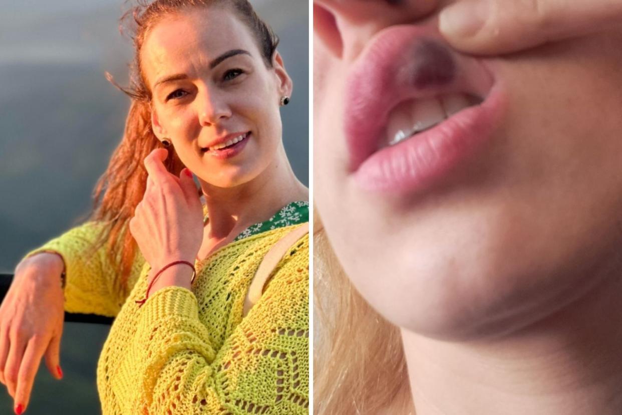 Edita Jucaite, 36, discovered she had leukaemia after a lip filler procedure caused her lips to swell and bruise. (Leukaemia UK/SWNS)