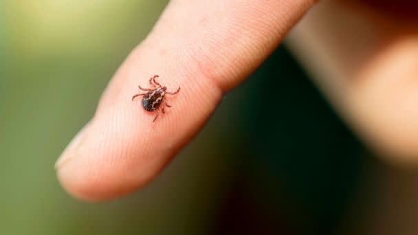 PHOTO: Stock photo of a tick on a finger. (STOCK PHOTO/Getty Images)