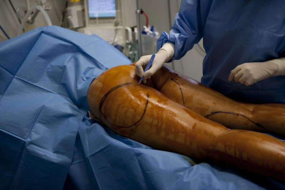 Photo Essay In Cosmetic Surgery. Incision With A Scalpel To Insert The Cannula. (Photo By BSIP/UIG Via Getty Images)