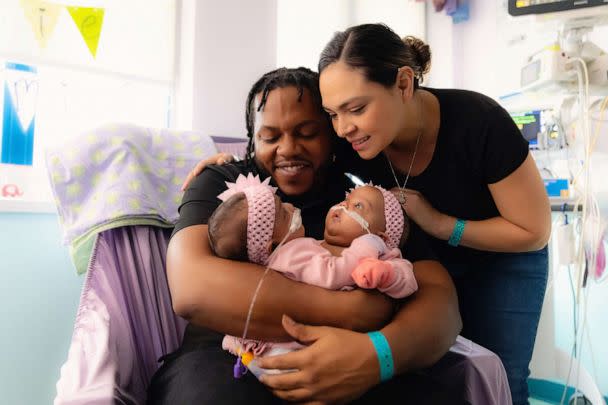PHOTO: Amanda Arciniega and James Finley hold their twin daughters, who were born conjoined. (Courtesy of Cook Children's Medical Center)