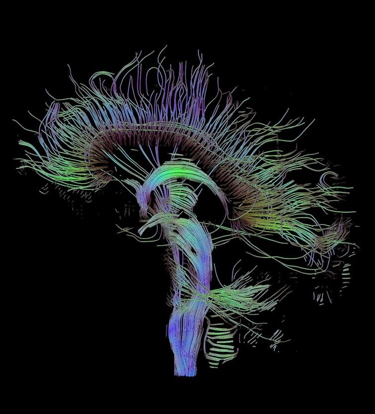 <span class="caption">Map of neural connections.</span> <span class="attribution"><span class="source">Thomas Schultz/wikimedia</span>, <a class="link " href="http://creativecommons.org/licenses/by-sa/4.0/" rel="nofollow noopener" target="_blank" data-ylk="slk:CC BY-SA;elm:context_link;itc:0;sec:content-canvas">CC BY-SA</a></span>