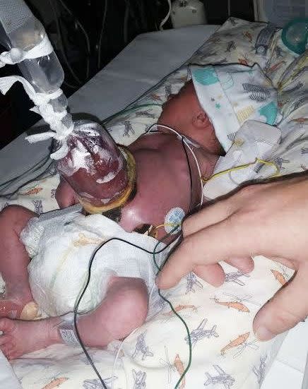 Gastroschisis affects one in every 5,000 babies and of those, 90-95 per cent survived the pregnancy. Photo: Supplied