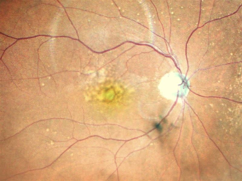 黃斑部有結疤組織，將影響中心視野，嚴重可能導致失明（圖／蔡景耀醫師提供）