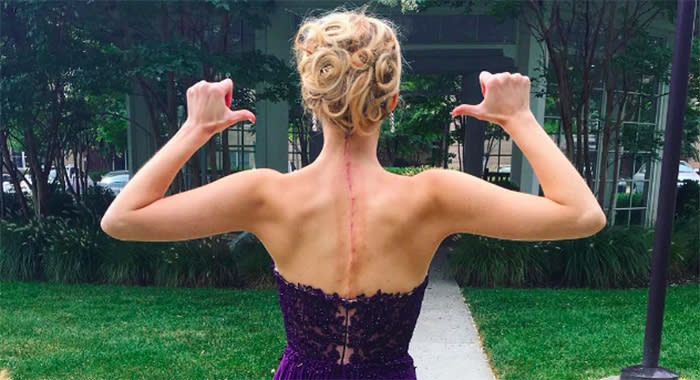 Beauty queen Victoria Graham, who has Ehlers-Danlos Syndrome, proudly shows her surgery scars. (Photo: Instagram/victonation)