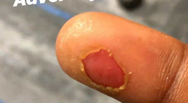 Marcus Stroman’s blister does not look like fun. (mstrooo6 // Instagram)