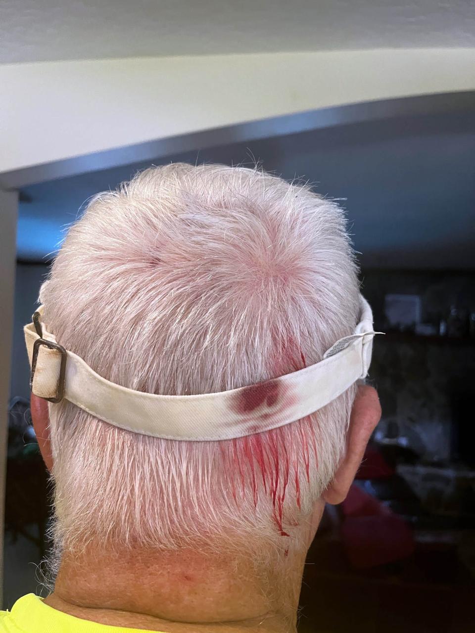 Terry Hayden of Titusville shows the injuries he received when he was attacked by a hawk while walking recently. Residents in the Whispering Hills neighborhood have reported being attacked by hawks nesting in the area.
(Photo: Photo provided by Terry Hayden)