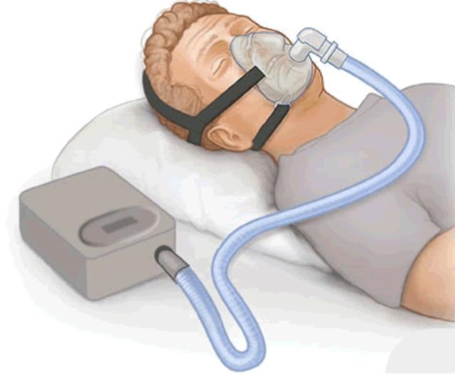 La FDA aprobó un nuevo dispositivo para el tratamiento de la apnea