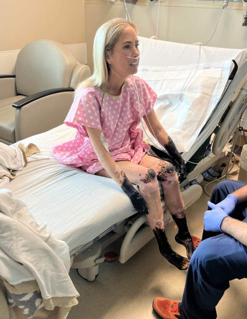 Sherri Moody in the hospital after her limbs were “mummified” following treatment that saved her life. Sherri Moody