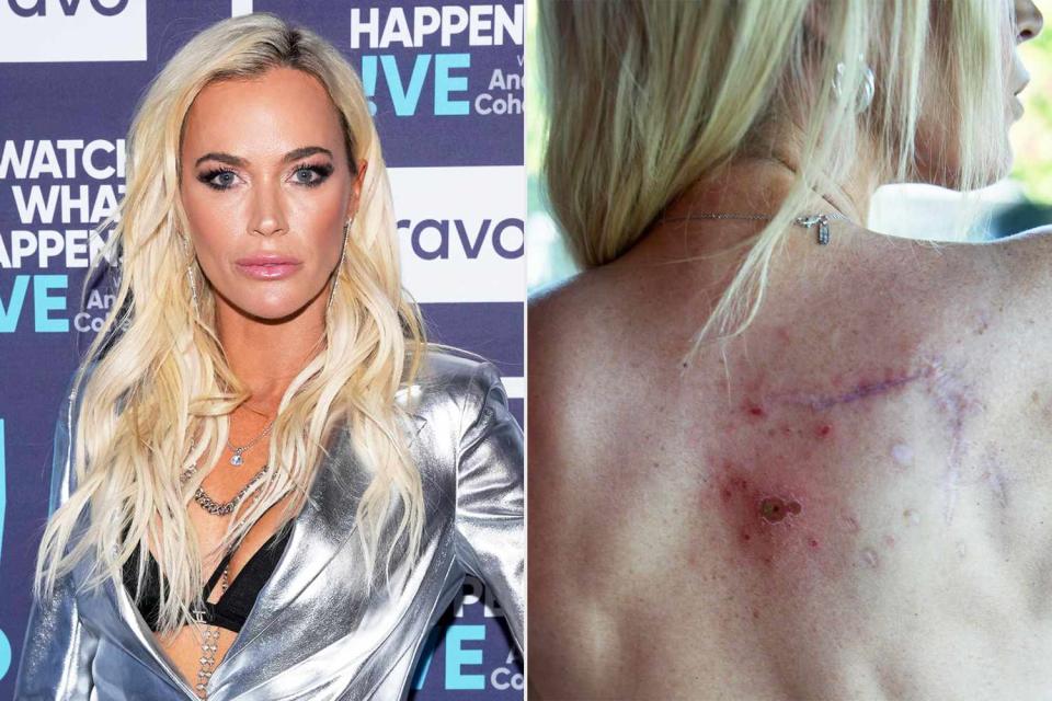 <p>Charles Sykes/Bravo/Getty; Teddi Mellencamp/Instagram</p> Teddi Mellencamp shares melanoma update