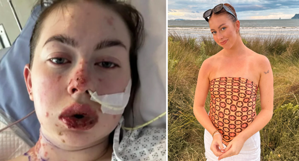 Charlotte Gilmour has a feeding tube in her nose with her nose, lips and neck covered in blisters (left). Gilmour stands smiling before her reaction, showing a comparison to her skin after the allergic reaction.  