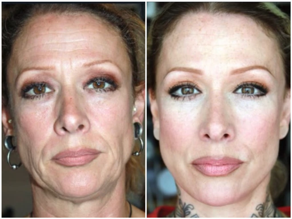 Jess Eaton before (L) and after (R) her facelift. (Jess Eaton)