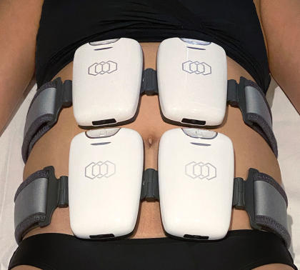 InMode’s Evolve radio-frequency energy device — which stimulates muscle contractions — secured to a patient’s abdomen. - Credit: Courtesy of Brand