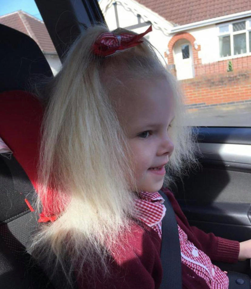 Lyla Grace suffers from uncombable hair syndrome. (Caters)