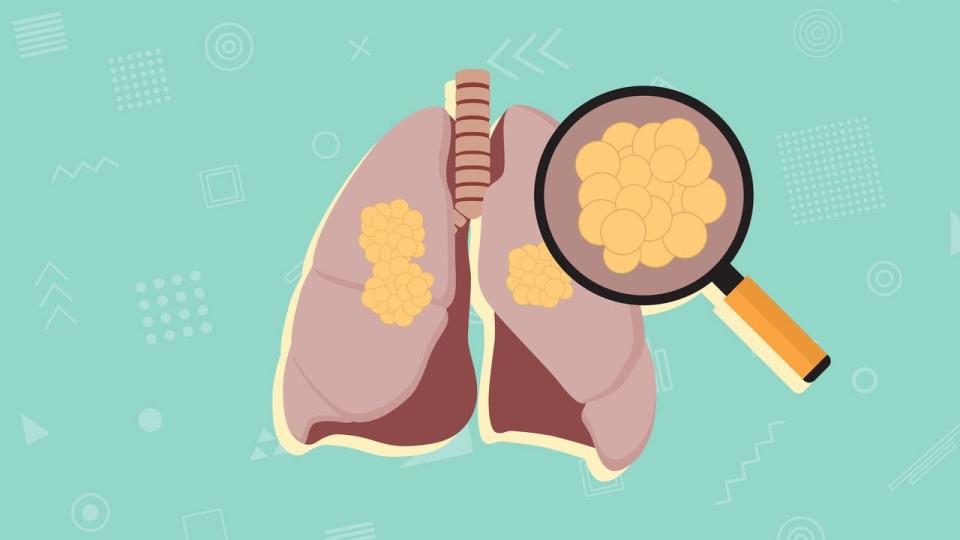 7 Causes of Lung Cancer in Non-Smokers