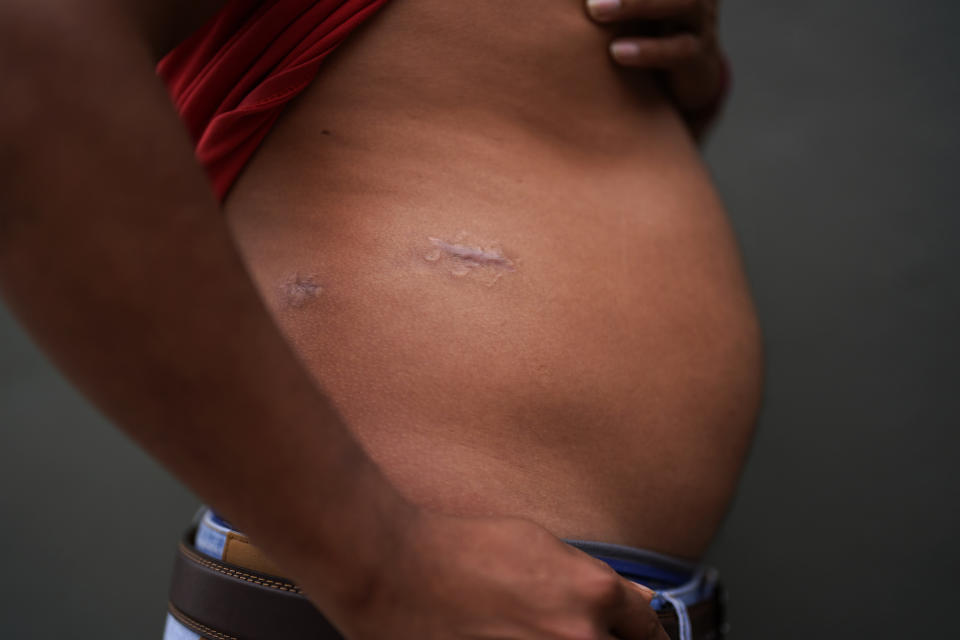 Asylum seeker Teodoso Vargas shows bullet wounds to his torso, after being shot nine times during a robbery in his native Honduras, Monday, May 22, 2023, as he waits to apply for asylum in the border city of Tijuana, Mexico. Asylum-seekers say joy over the end of the public health restriction known as Title 42 this month is turning into anguish with the realization of how the Biden administration's new rules affect them. Though the government opened some new avenues for immigration, many people's fate is largely left up to a U.S. government app that is limited and unable to decipher and prioritize human suffering and personal risk. (AP Photo/Gregory Bull)