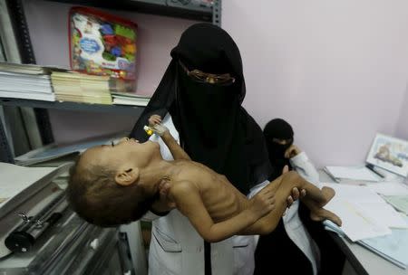 A nurse holds a malnourished child at a hospital in Yemen's capital Sanaa July 28, 2015. The war in Yemen has killed more than 3,500 people. REUTERS/Khaled Abdullah