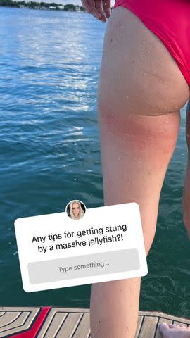 <p>Lindsey Vonn Instagram</p> Lindsey Vonn's jellyfish sting