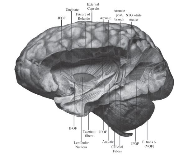 A drawing of a postmortem brain that includes the vertical occipital fasciculus (bottom left) published by neuroscientist E.J. Curran in 1909.