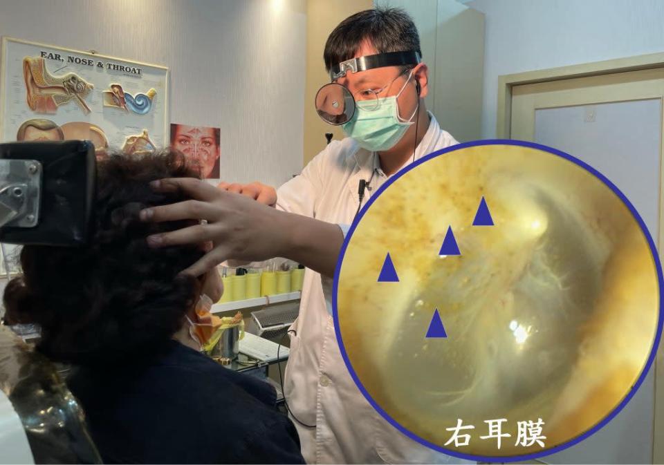 醫師陳建志為患者診療，箭頭所指為黑色點狀的菌絲，散布於耳道及耳膜上。 （醫師陳建志提供）