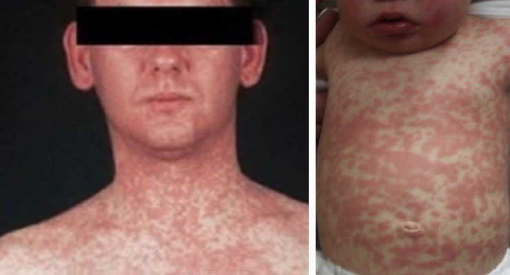 A man with a rash (left) and a baby with a rash (right)