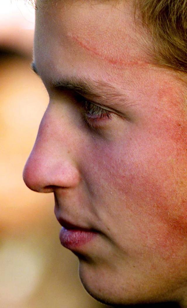 Prince William Has A Harry Potter Scar On His Forehead ​And The Story  Behind It Is Wild