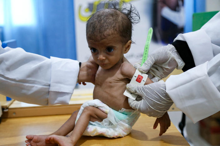 A technician takes the upper arm measurement, 8 centimeters, of a malnourished child wearing a disposable diaper that is far too large.