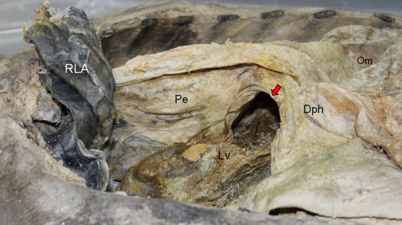 An arrow points to the hole in the mummy's diaphragm, through which the liver (labeled Lv) is protruding, pushing up against the lung.