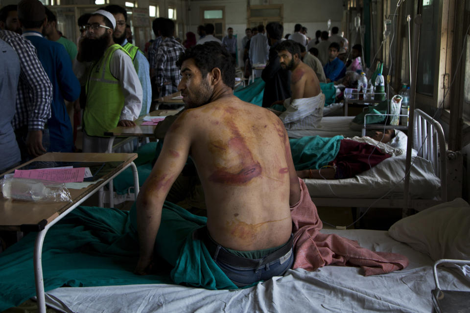 FILE - In this Aug. 18, 2016 file photo, Sameer Ahmed, a Kashmiri man allegedly beaten up by Indian soldiers at Khrew village, recovers at a local hospital in Srinagar, Indian controlled Kashmir. A prominent rights group in Indian-controlled Kashmir is advocating United Nations to establish a commission of inquiry to probe endemic use of torture by government forces who have faced decades long anti-India uprising in the disputed region. (AP Photo/Dar Yasin, File)