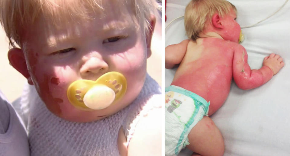 Nicholas suffered second-degree burns after picking up the garden hose on a scorching day. Source: KNXV