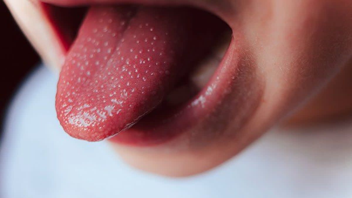 A common early symptom of the disease is a red and swollen tongue with red spots, referred to as ‘strawberry tongue’ (Getty)