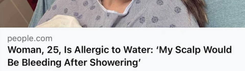Article headline about a 25-year-old woman allergic to water, discussing her experience with scalp bleeding after showers