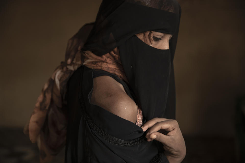 In this July 21, 2019 photo, Ethiopian migrant Eman Idrees shows her shoulder with a wound from torture after being held and abused for eight months in a desert compound known in Arabic as a "hosh," run by an Ethiopian smuggler in Ras al-Ara, Lahj, Yemen. (AP Photo/Nariman El-Mofty)