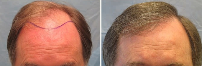 male hair transplant