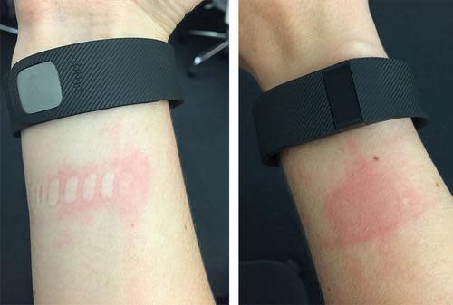 Rash from Fitbit Charge