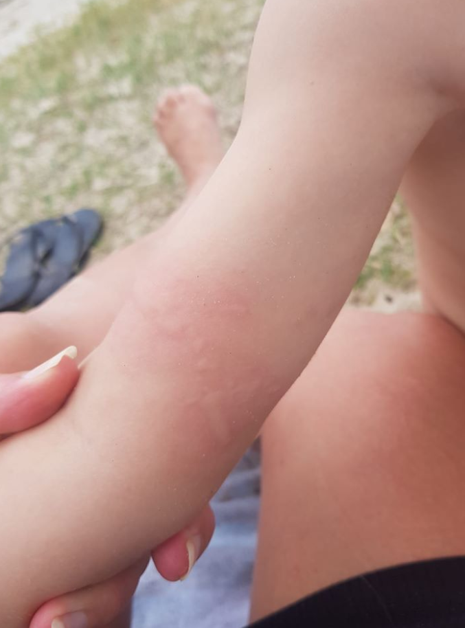 A child's jellyfish sting also from the Noosa River. Source: Facebook