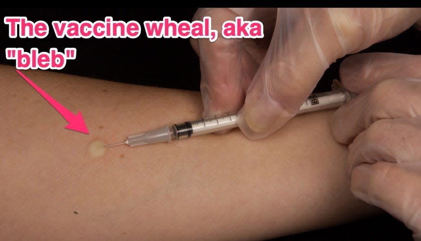 photo of intradermal vaccine being administered, resulting in bubble of vaccine liquid just under surface of skin