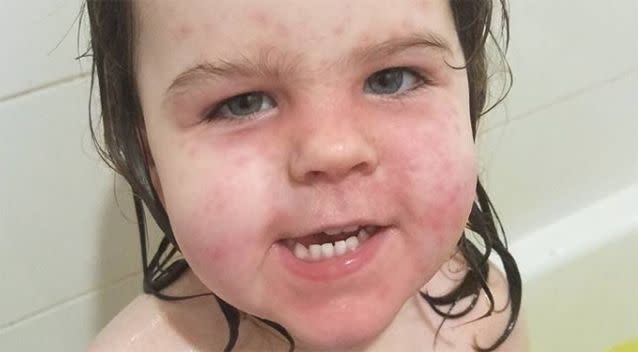 Two-year-old Kaylee was left with rashes on her face. Source: Facebook